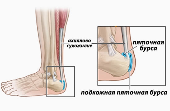 Тендинит ахиллова сухожилия лечение. Ахиллово сухожилие анатомия сумка ахиллова. Ахиллово сухожилие бурсит. Сумки ахиллова сухожилия анатомия. Ахиллобурсит голеностопного.