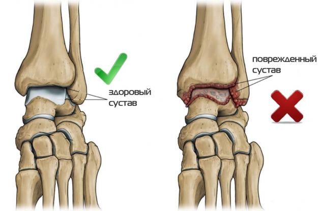Подагра голеностопного сустава фото