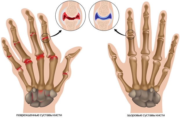 Артроз мелких суставов
