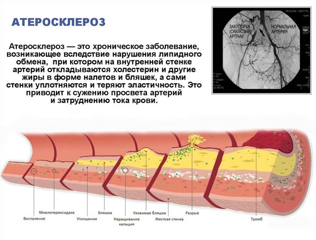 Атеросклероз сосудов фото