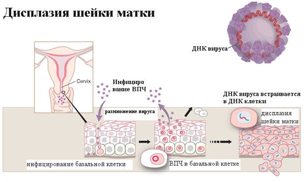 Дисплазия шейки матки картинки