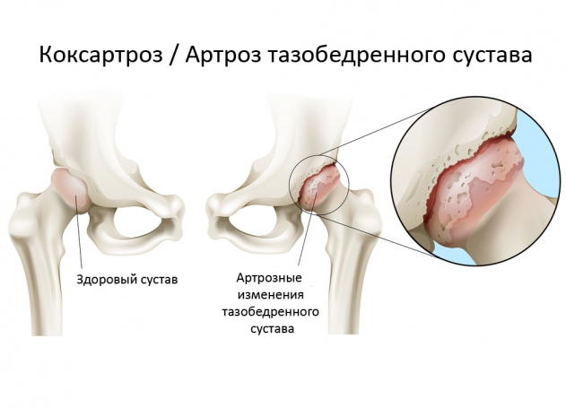 лечение степеней коксартроза тазобедренного сустава