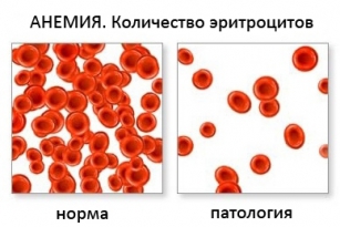 Анемия