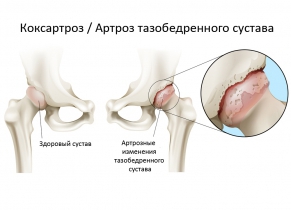 Коксартроз (артроз тазобедренного сустава)