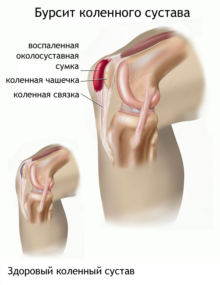 коленный бурсит лечение