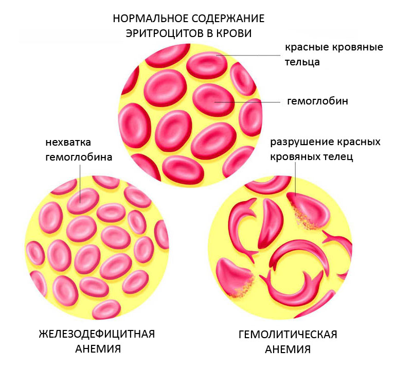 содержание эритроцитов при анемии