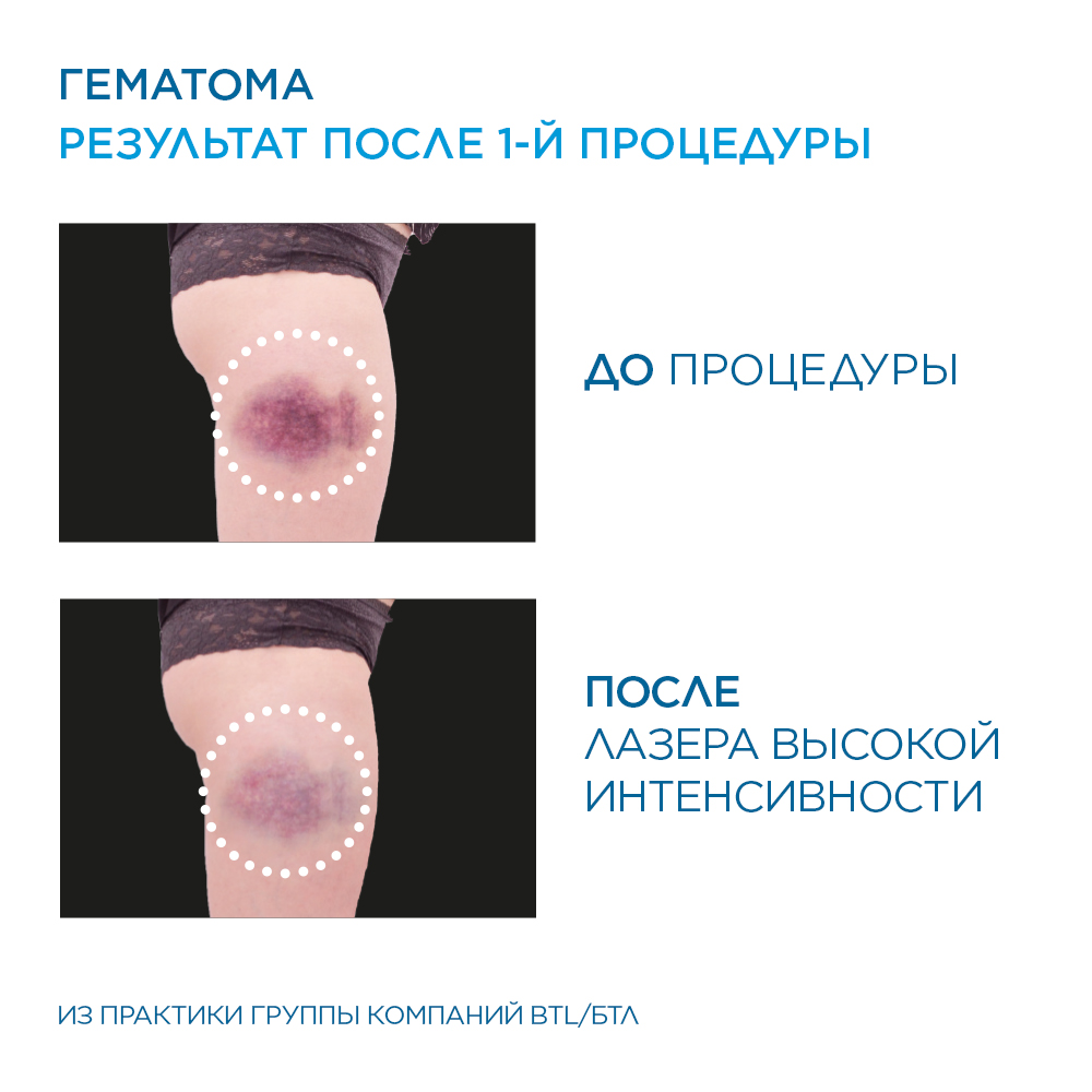 ХИЛ-терапия. Лечение гематомы